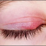 Eye Diseases and Infections