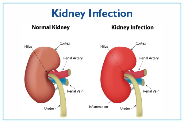 kidney infection symptoms